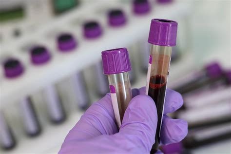 ultralab test|Blood lab test in .